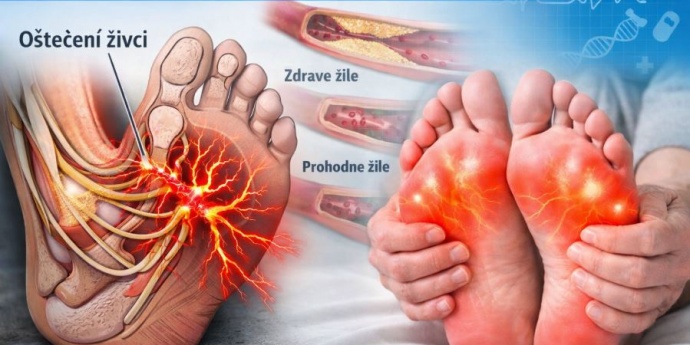 Dijabetička neuropatija – prirodna biljna podrška za žarenje, peckanje i trnce u stopalima