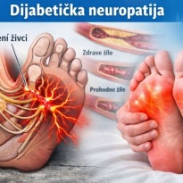 Dijabetička neuropatija – prirodna biljna podrška za žarenje, peckanje i trnce u stopalima