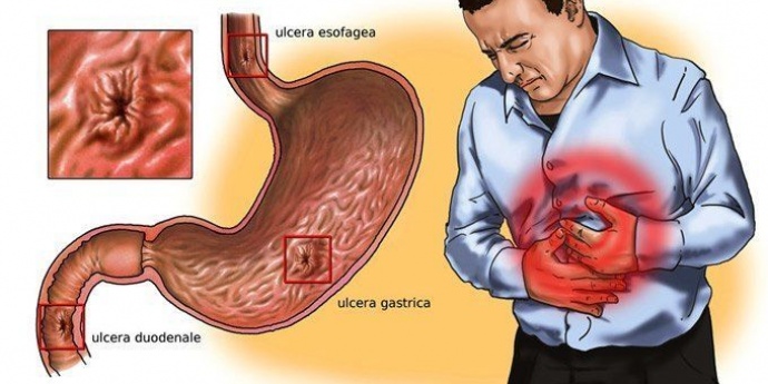 GASTRITIS