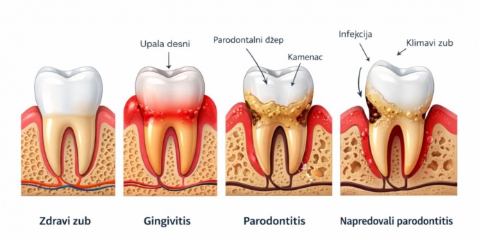 Paradentoza – uzroci, simptomi i biljna terapija za zdrave desni